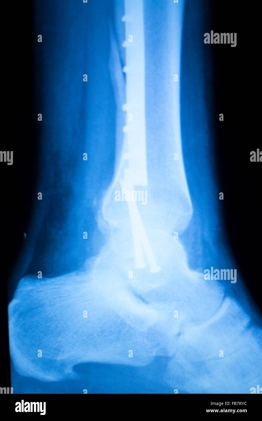 Foot ankle and shin orthopedics xray scan results showing Traumatology