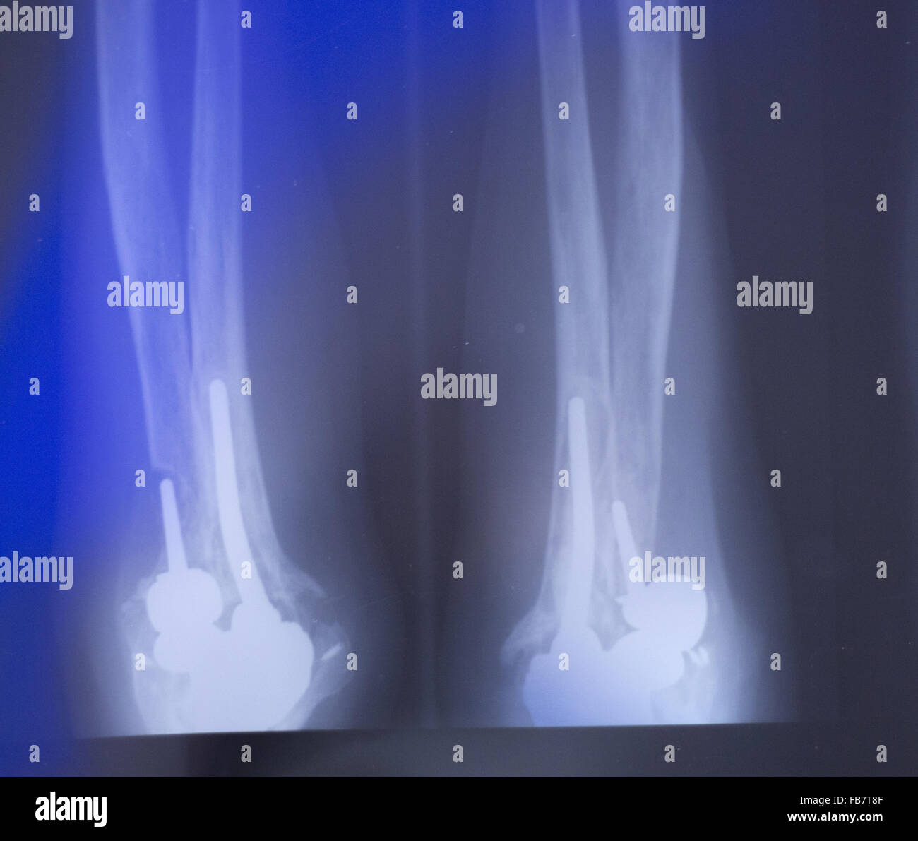 Othopedics and Traumatology surgical implant arm and elbow xray test