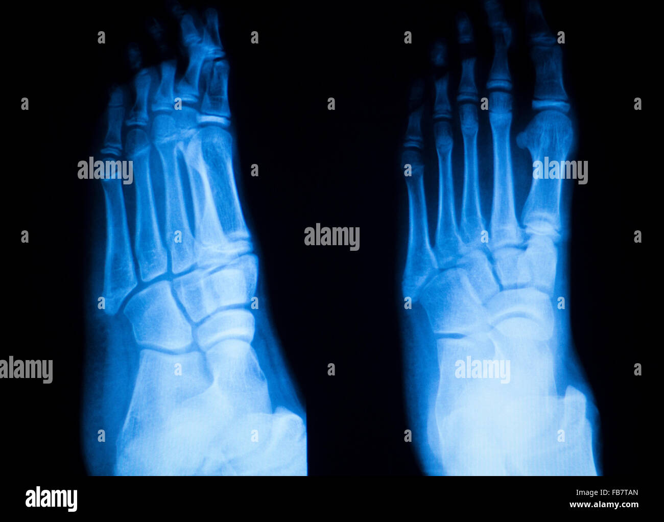Foot and toes injury xray scan orthopedics and Traumatology radiology