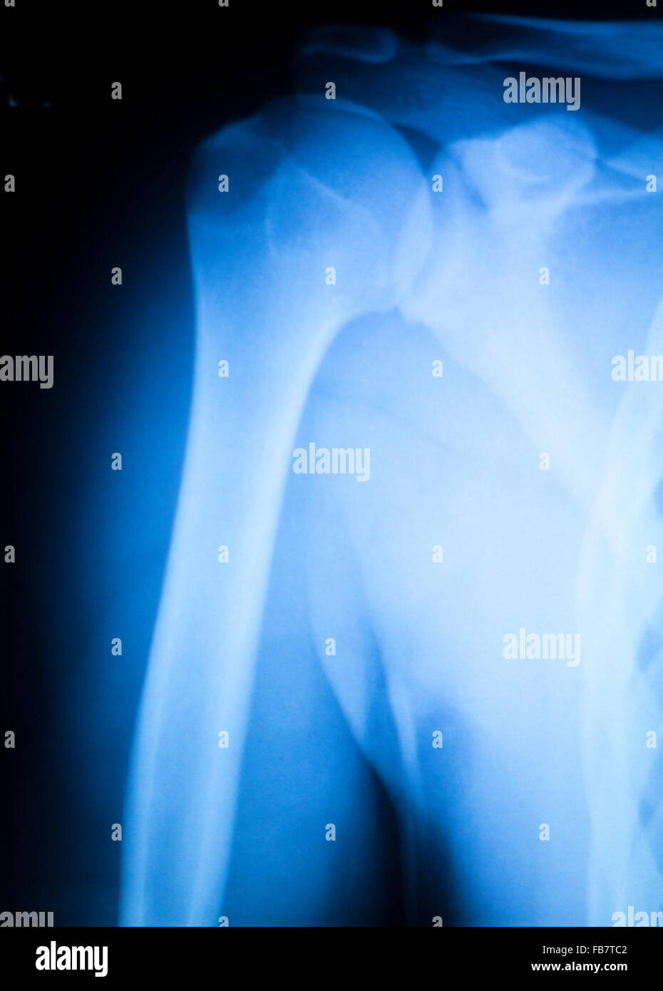 Arthritic hip xray test scan orthopedic and Traumatology results Stock