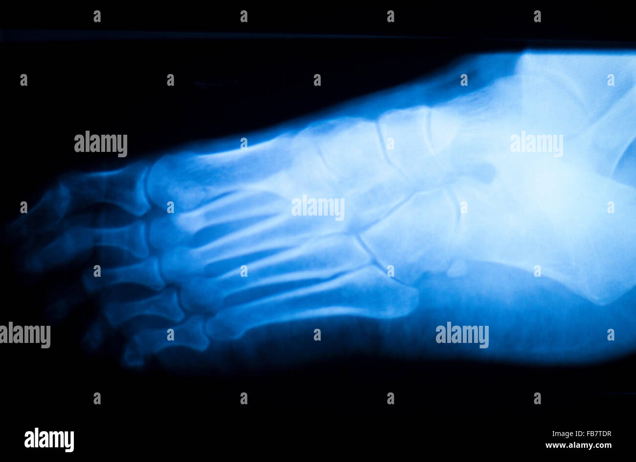 Foot and toes injury xray scan orthopedics and Traumatology radiology