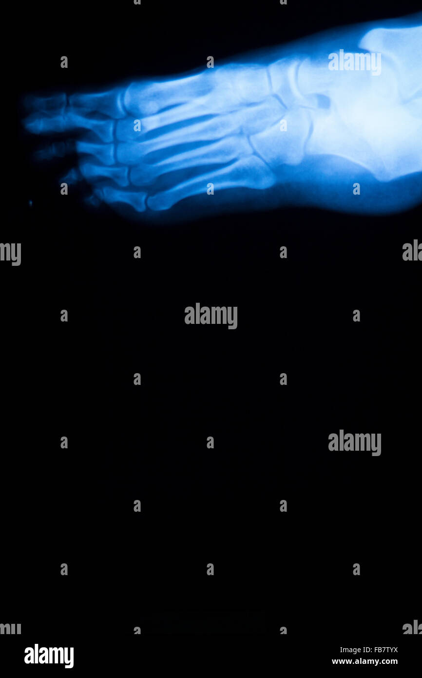 Foot and toes injury xray scan orthopedics and Traumatology radiology