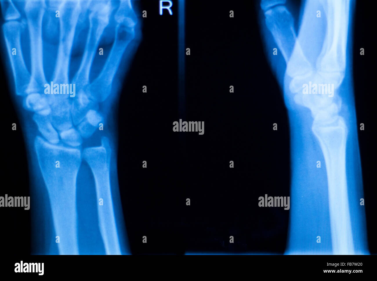 Othopedics and Traumatology surgical implant arm and elbow xray test