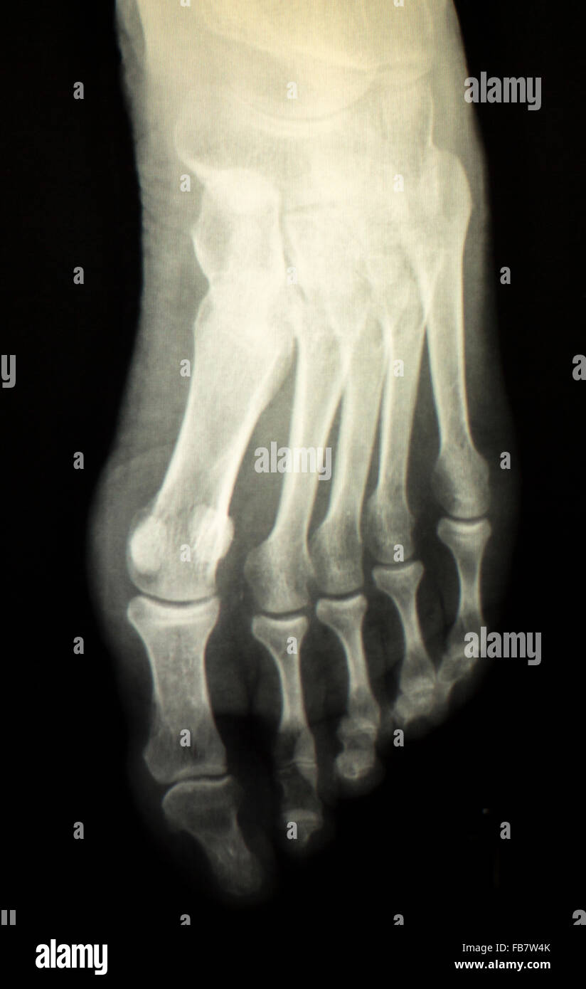 Foot and toes injury xray scan orthopedics and Traumatology radiology