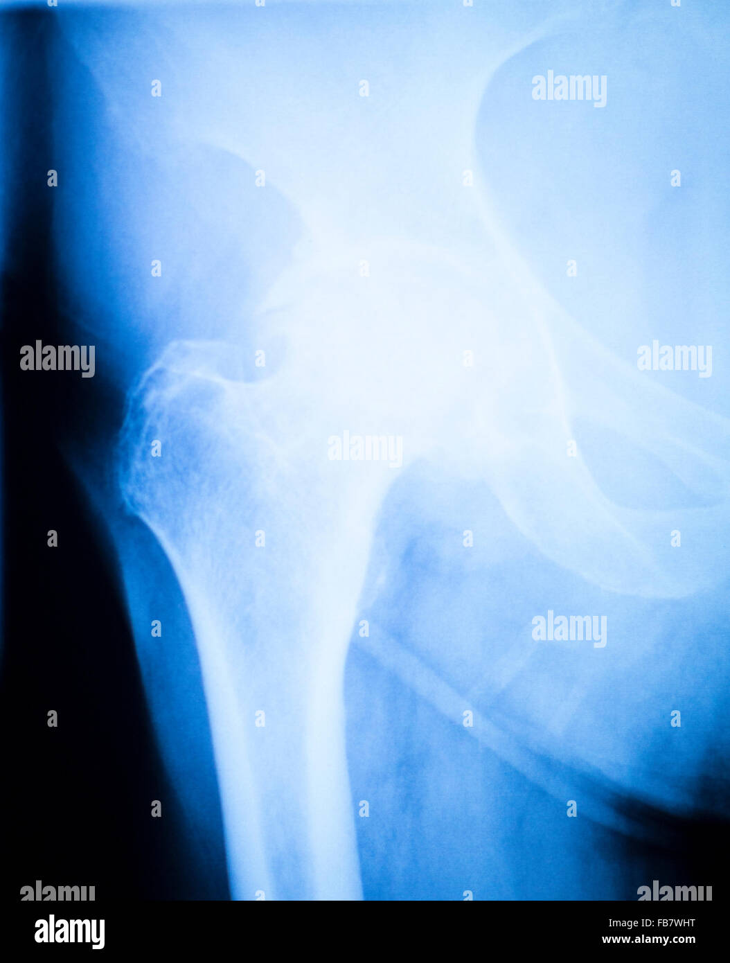 Arthritic hip xray test scan orthopedic and Traumatology results Stock