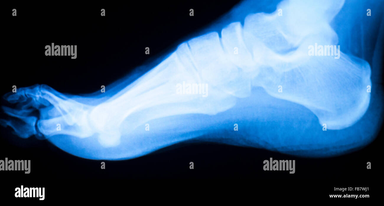 Foot and toes injury xray scan orthopedics and Traumatology radiology