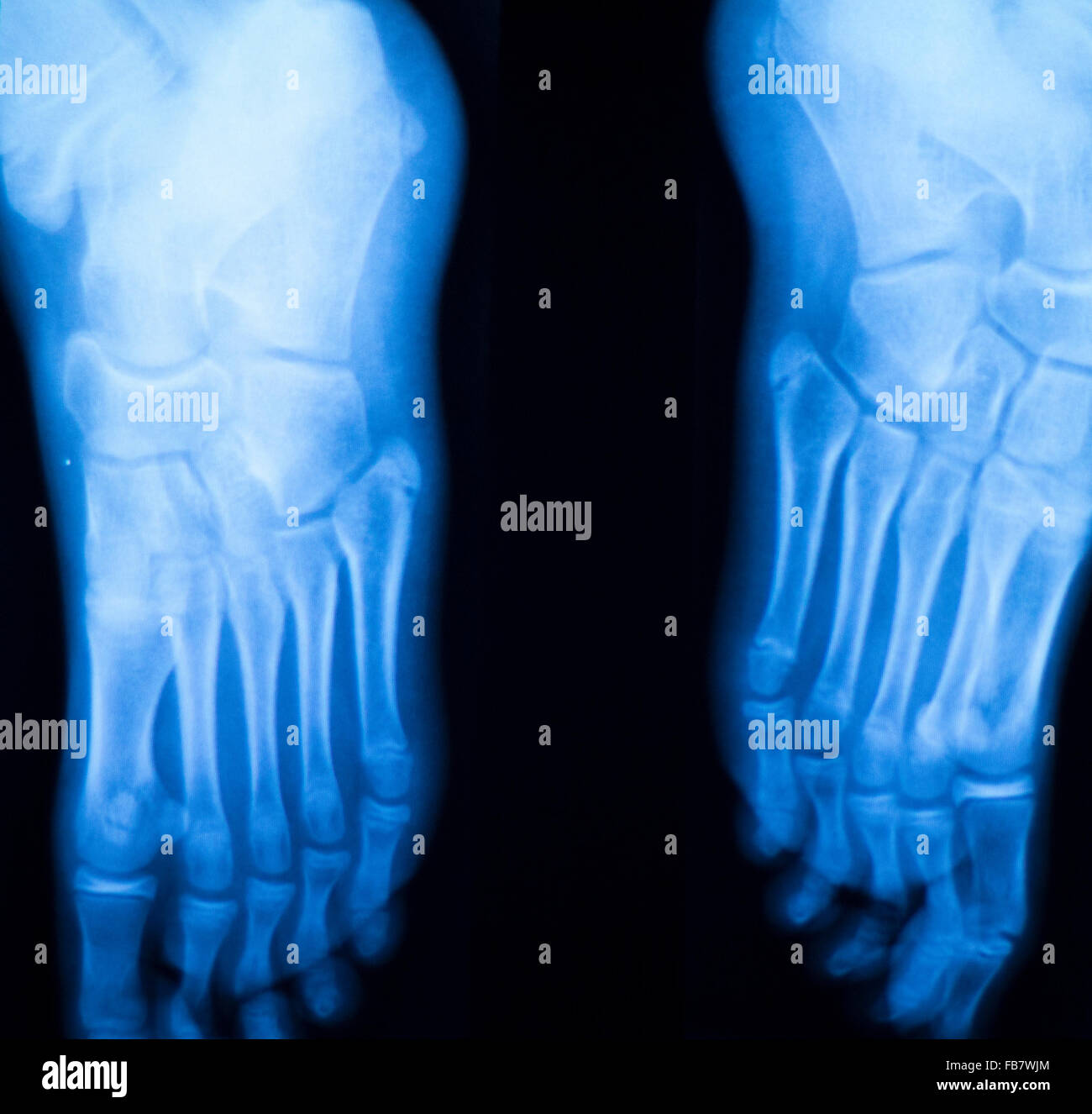 Foot and toes injury xray scan orthopedics and Traumatology radiology