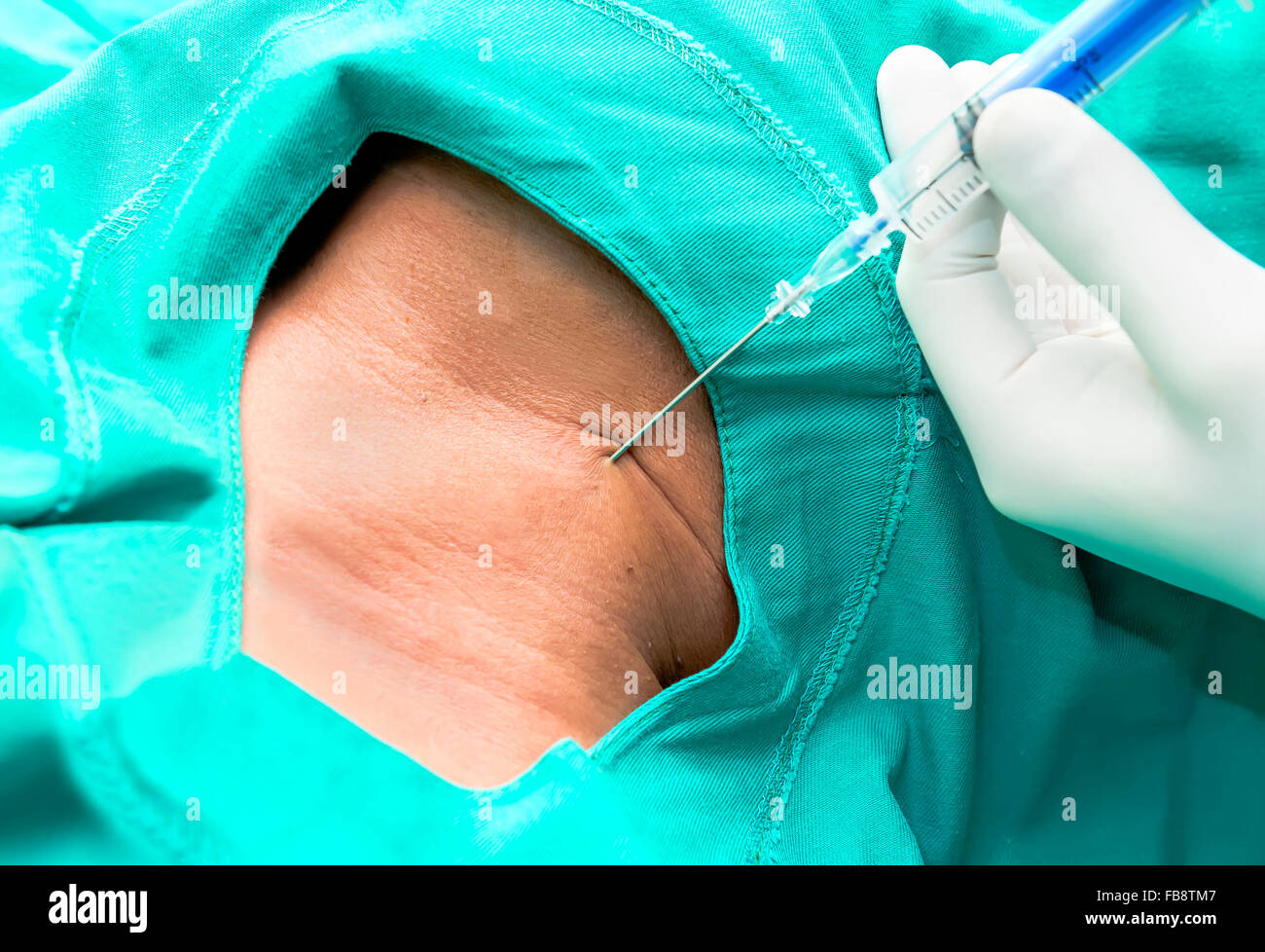 Placement of a central venous catheter Stock Photo