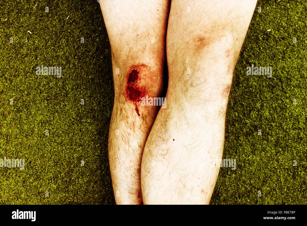 Close up bruised knee hires stock photography and images Alamy