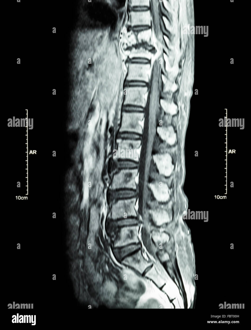 Spine metastasis ( cancer spread to thoracic spine ) ( MRI of thoracic and lumbar spine : show thoracic spine metastasis and com Stock Photo