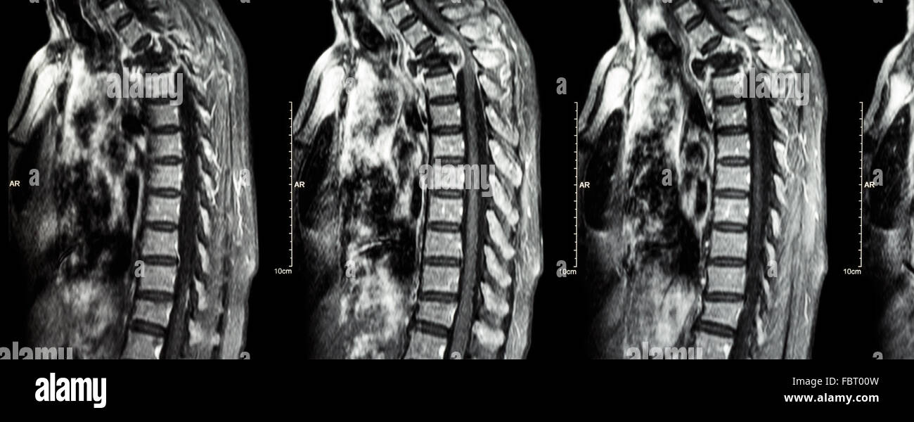 Spine metastasis ( cancer spread to thoracic spine ) ( MRI of cervical and thoracic spine : show thoracic spine metastasis and c Stock Photo