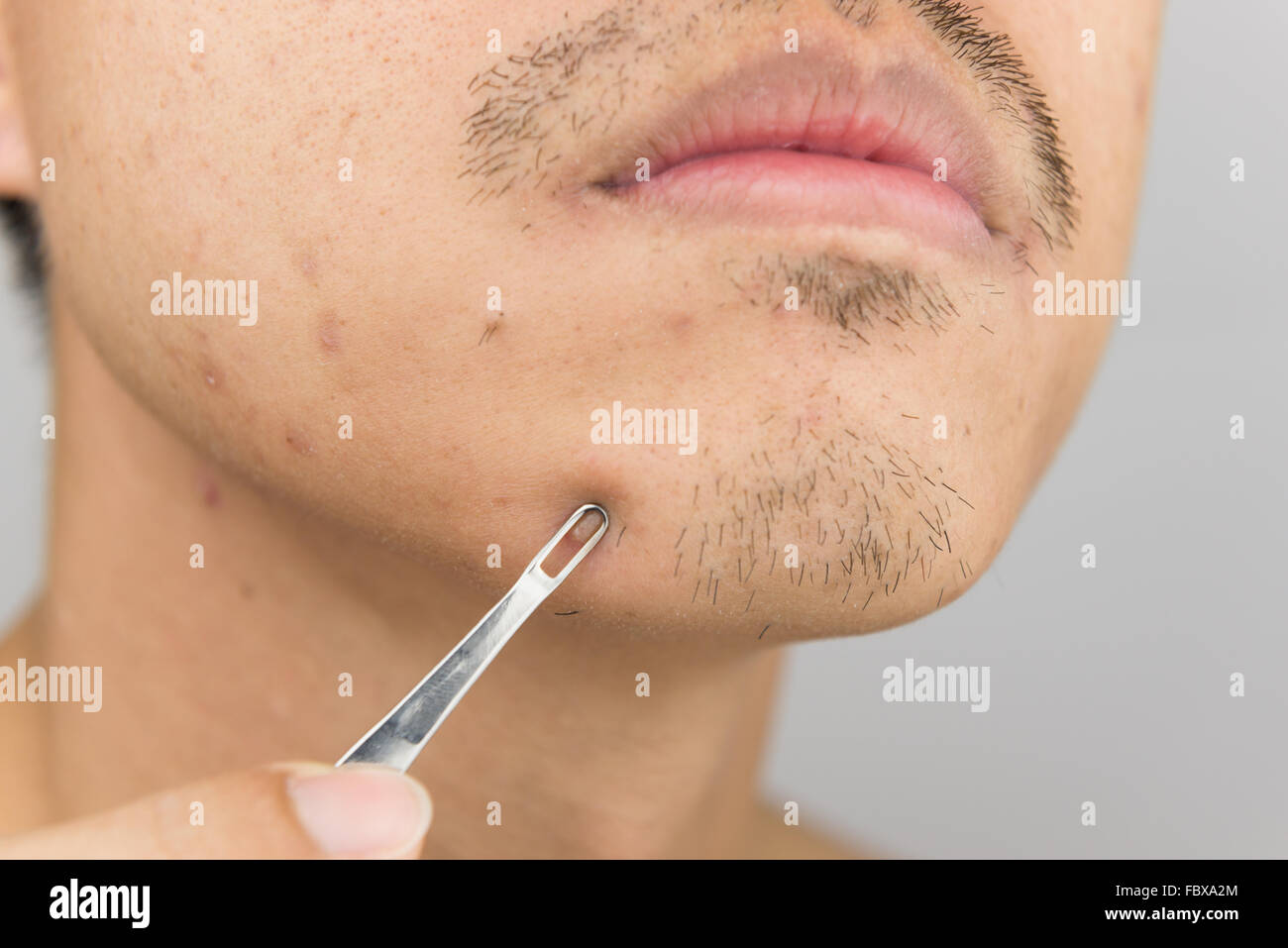 acne treatment using pimple extractor tool Stock Photo