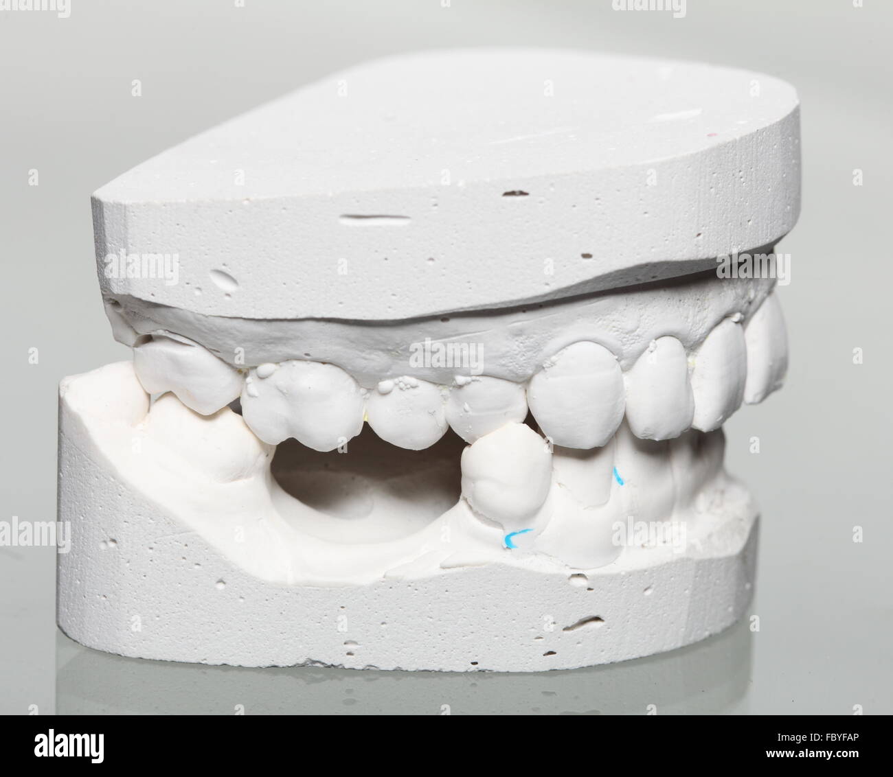 Dental gypsum model mould of teeth in plaster Stock Photo