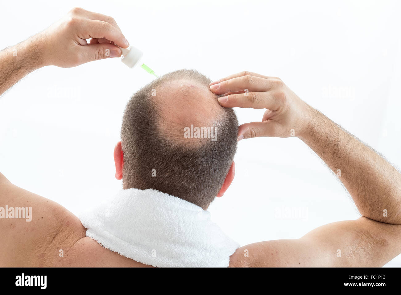 ALOPECIA Stock Photo Alamy