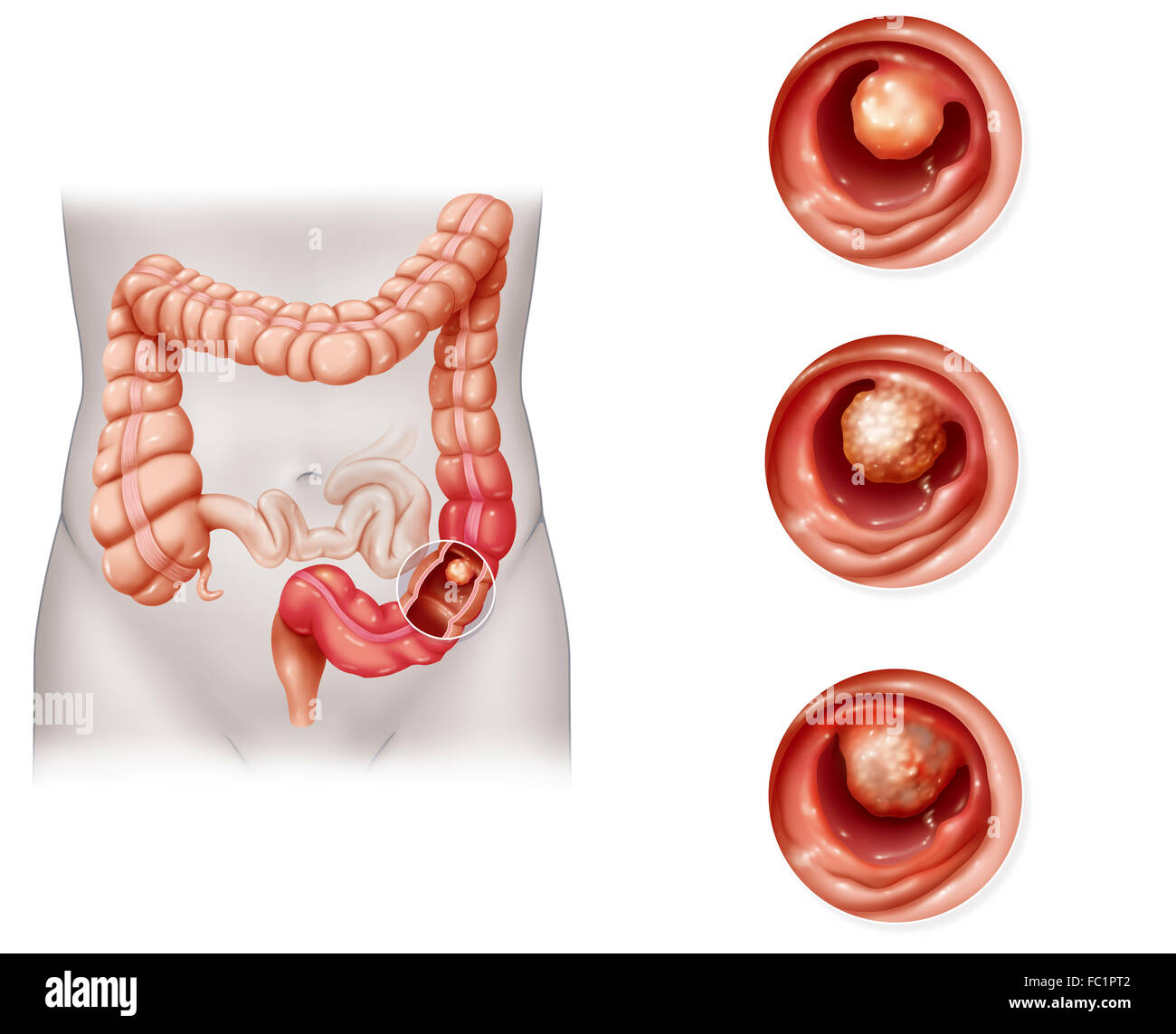 CANCER OF THE COLON, DRAWING Stock Photo
