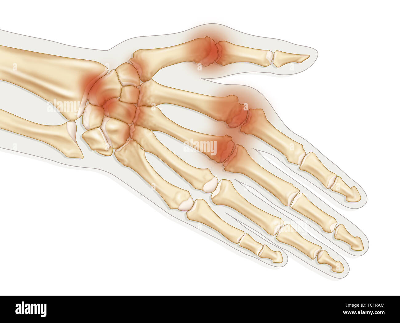 RHEUMATOID ARTHRITIS, DRAWING Stock Photo