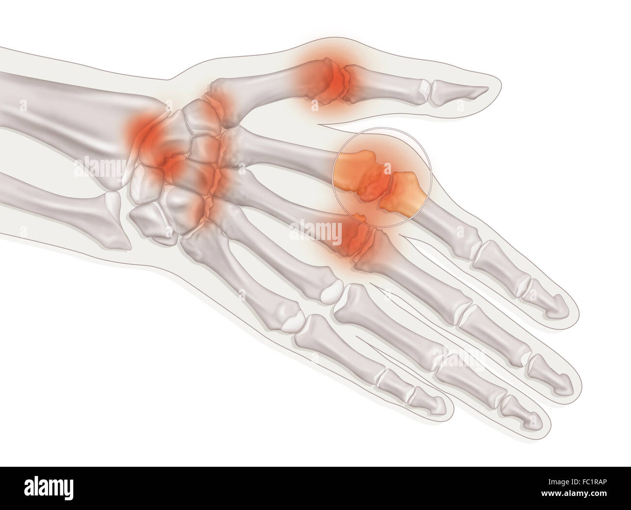 RHEUMATOID ARTHRITIS, DRAWING Stock Photo