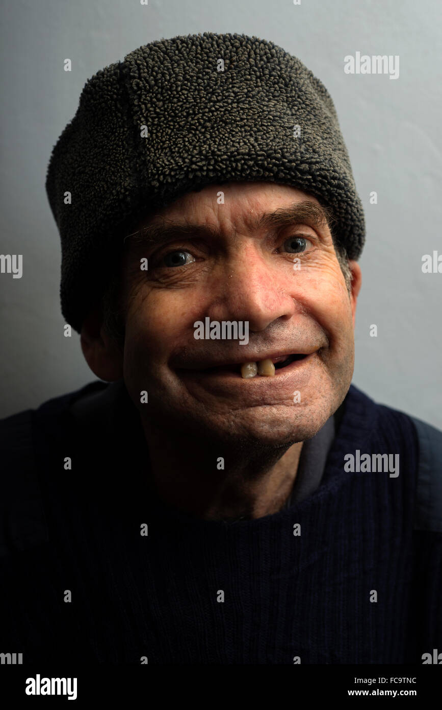 Man with metal health problems living with inoperable throat cancer