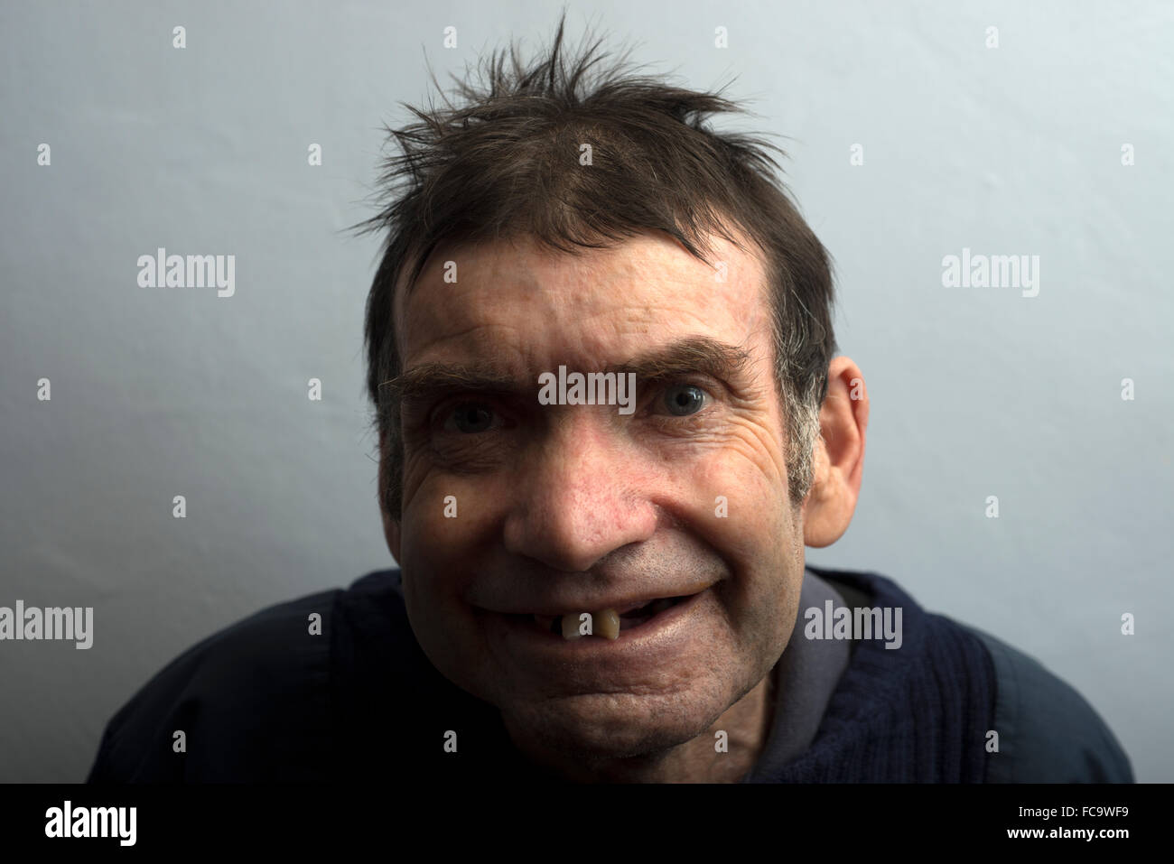 Man with metal health problems living with inoperable throat cancer