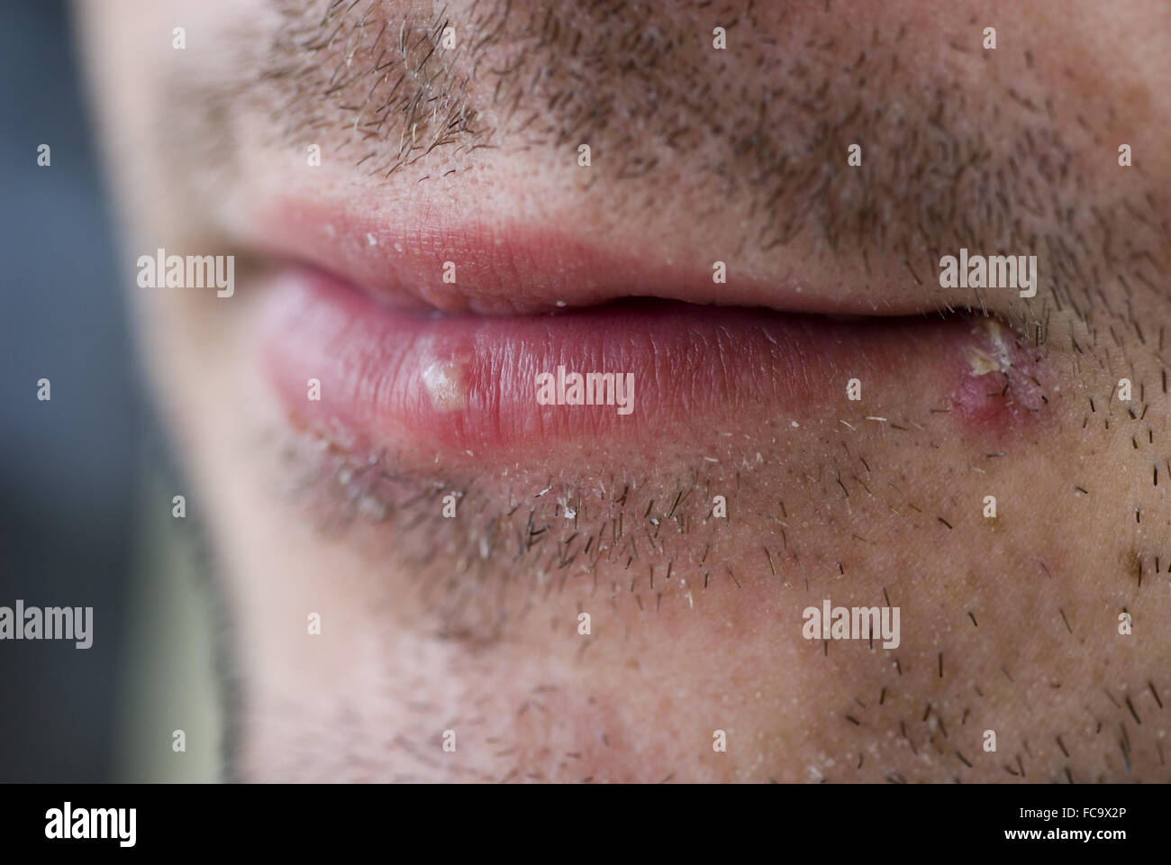 Cold sores (herpes labialis) Stock Photo