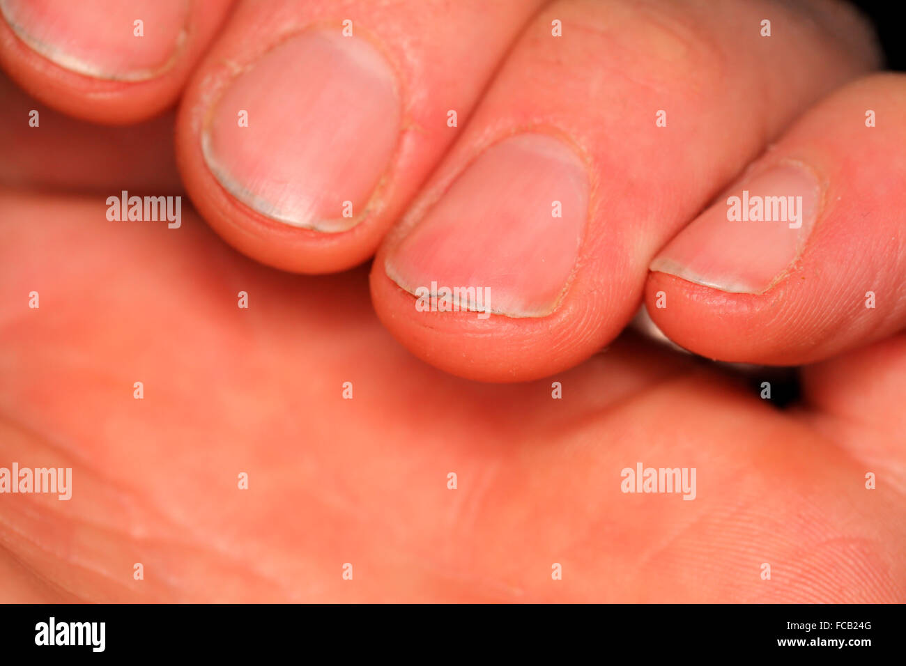 Dirty, irregular fingernails. Stock Photo