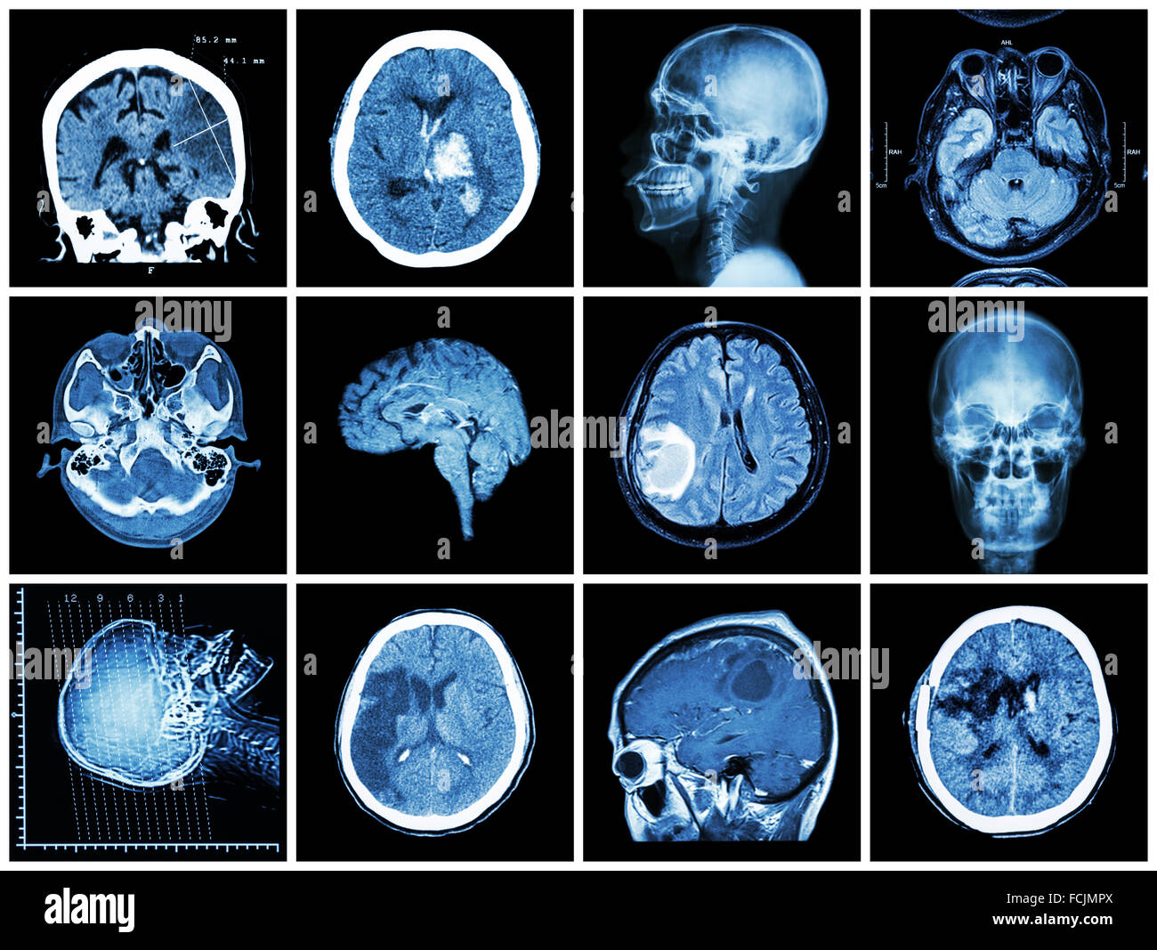 Collection of brain disease ( CT scan and MRI of brain : show cerebral infarct , intracerebral hemorrhage , brain tumor , basal Stock Photo