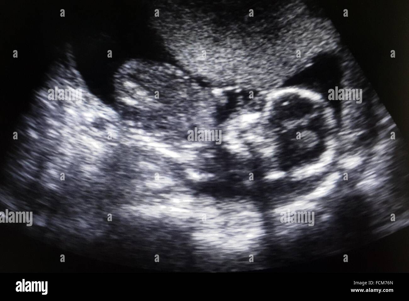 Obstetric ultrasound obtein a Picture of a foetus using ultra-sound machine. Stock Photo