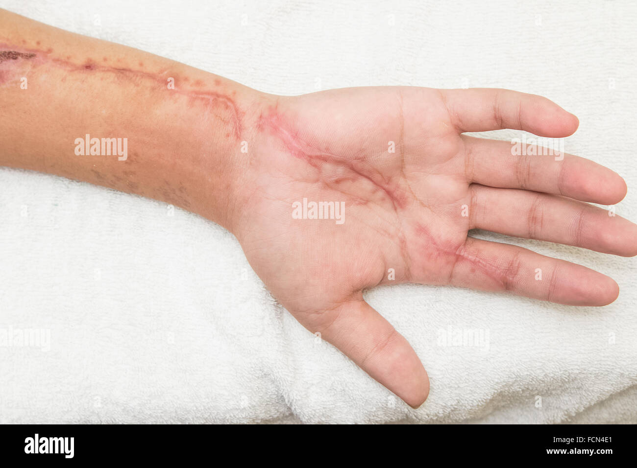 Scab scar hires stock photography and images Alamy
