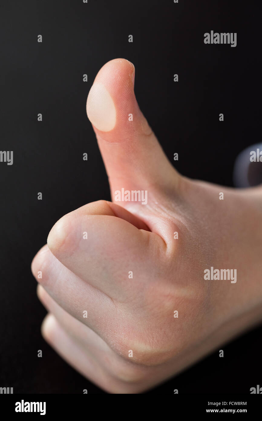 Friction blister on the left thumb of a 6 year old caucasian boy. Caused by prolonged use of a computer gaming controller, demonstrating one of the dangers of children playing computer games. January, 2016, England, UK. Stock Photo