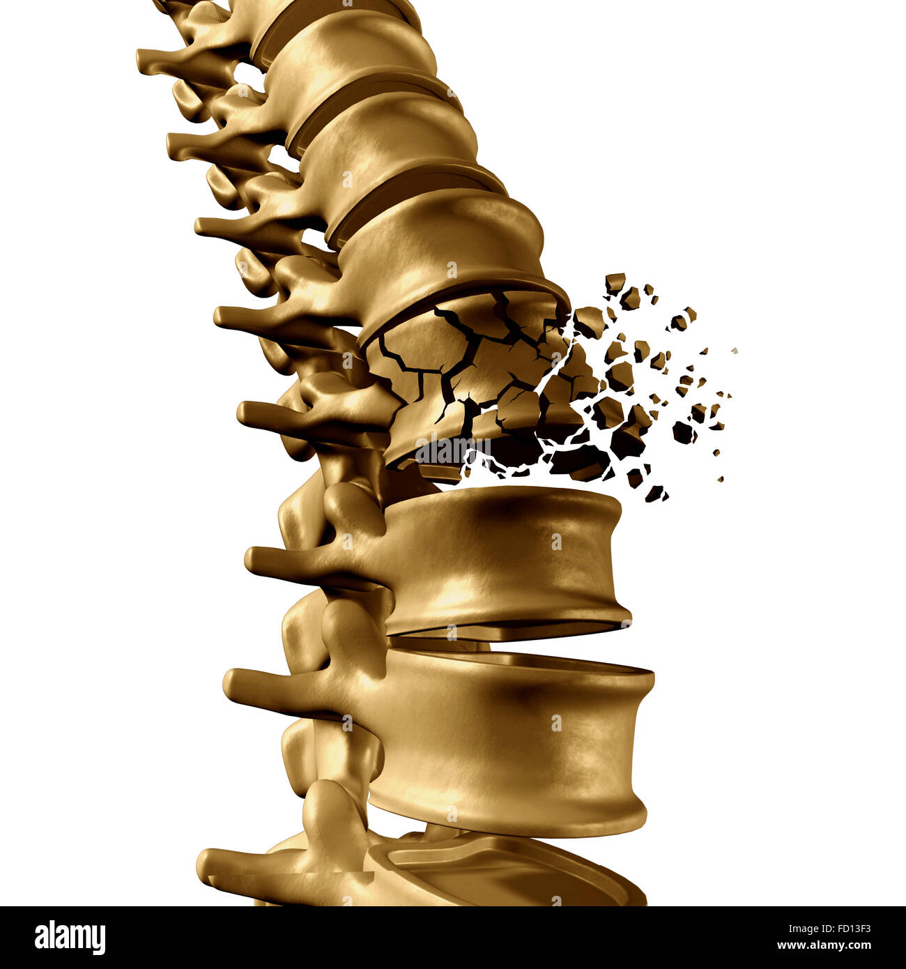 Spinal Fracture and traumatic vertebral injury medical concept as a human anatomy spinal column with a broken burst vertebra due to compression or other osteoporosis back disease on a white background. Stock Photo