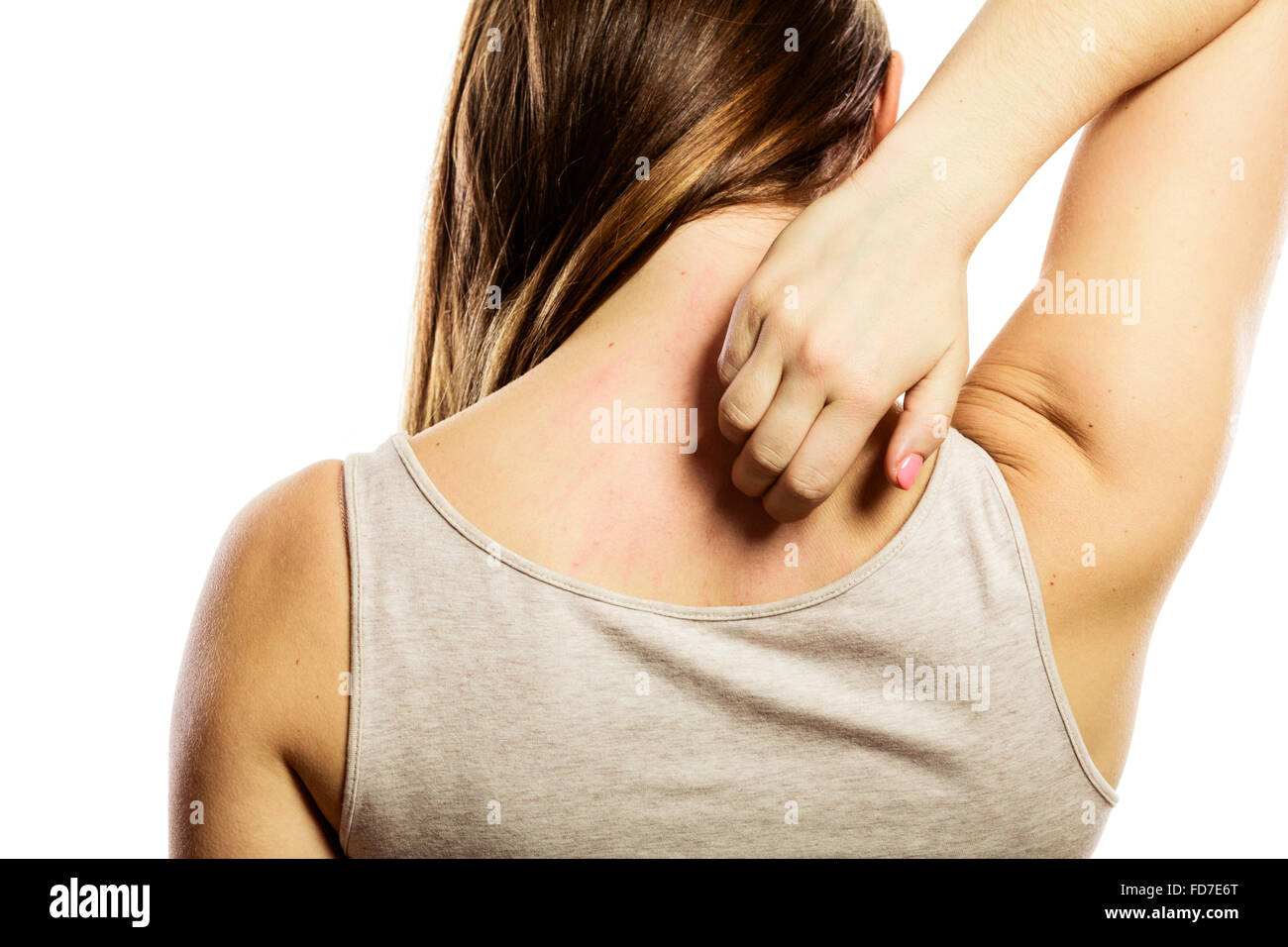 Health problem. Young woman scratching her itchy back with allergy