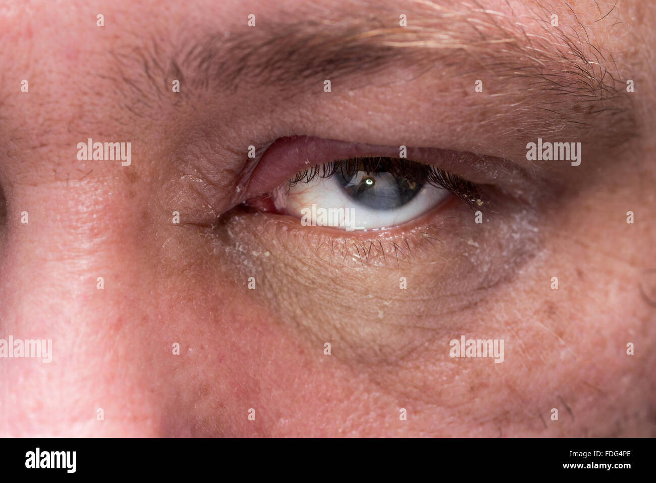 Close Up Of Eye Infection With Swollen Eyelid Stock Photo Alamy