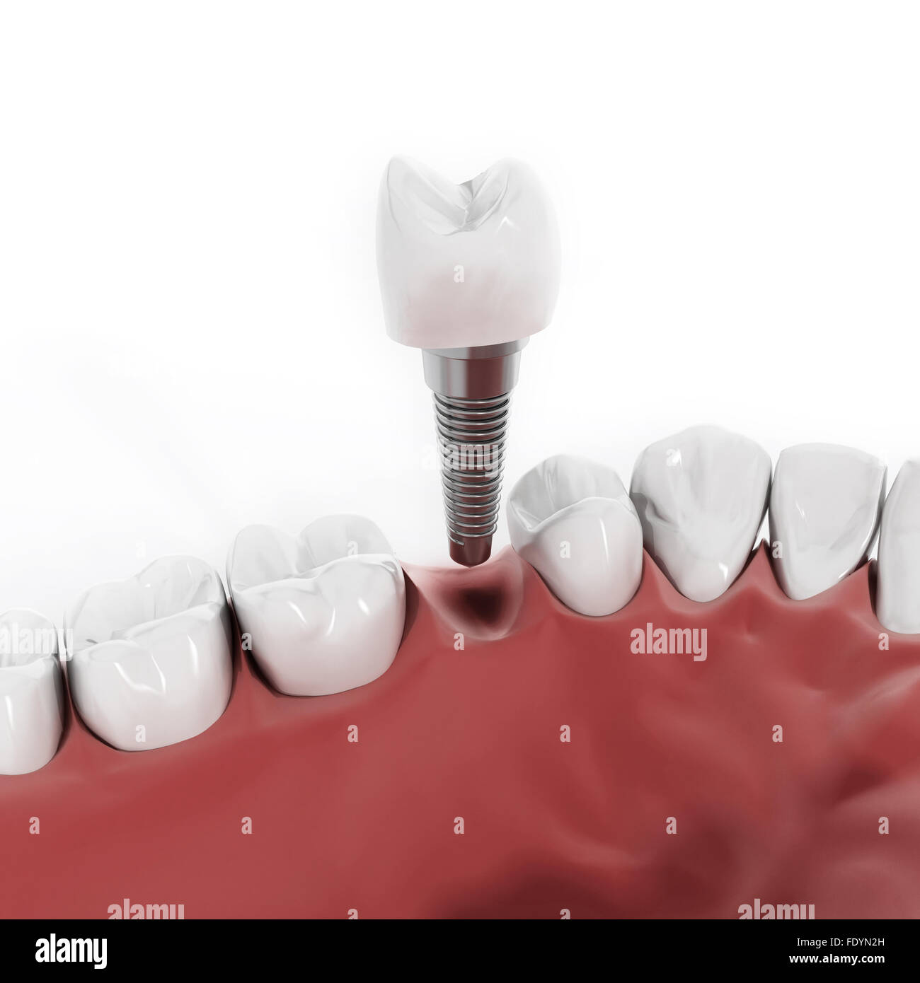 Illustration of teeth showing dental implant structure Stock Photo Alamy