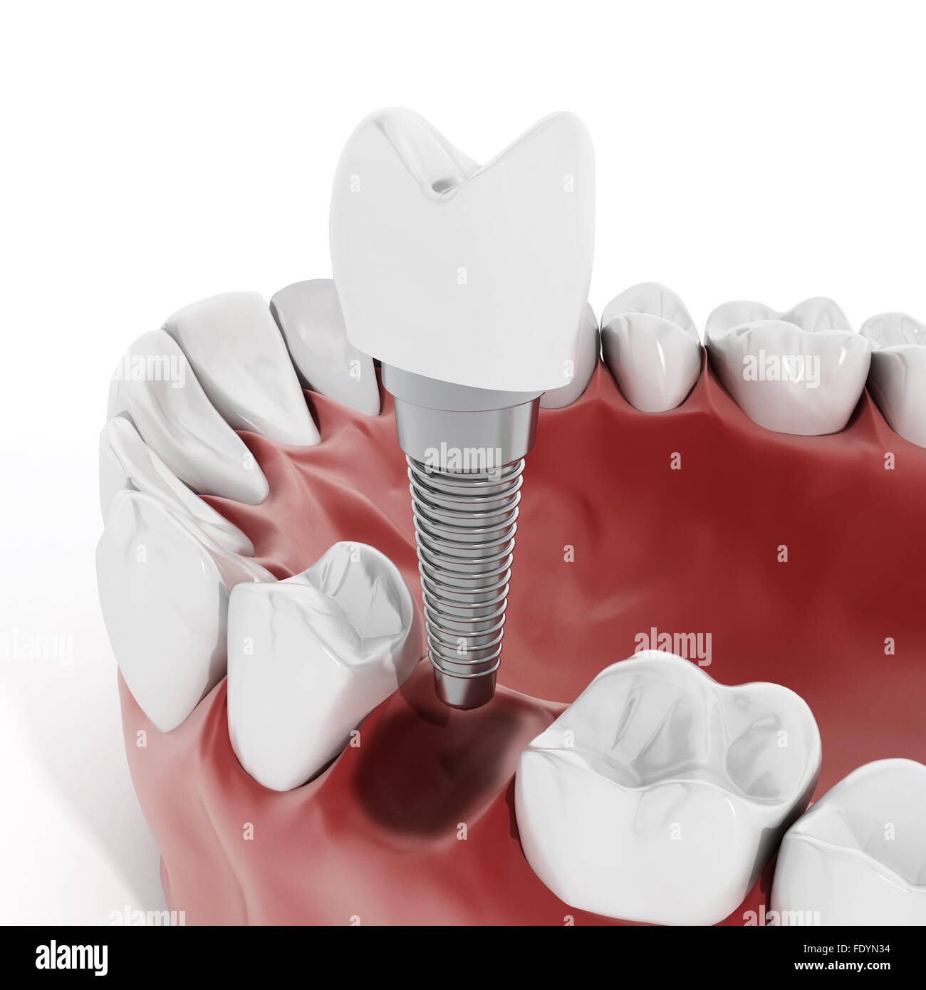 Illustration of teeth showing dental implant structure Stock Photo Alamy