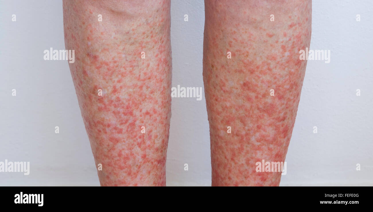 woman-s-lower-legs-exhibiting-the-itchy-rash-associated-with-a-severe