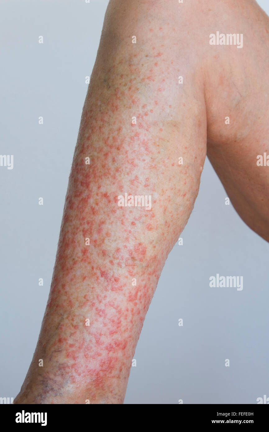Woman's lower leg exhibiting the itchy rash associated with a severe case of polymorphic light eruption. Stock Photo