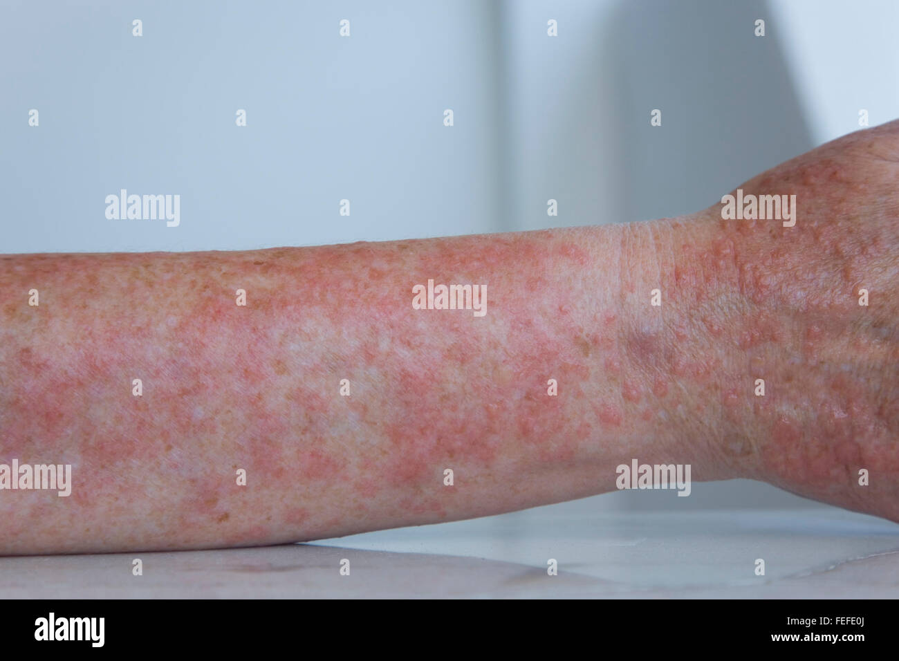 Woman's forearm exhibiting the itchy rash associated with a severe case of polymorphic light eruption. Stock Photo