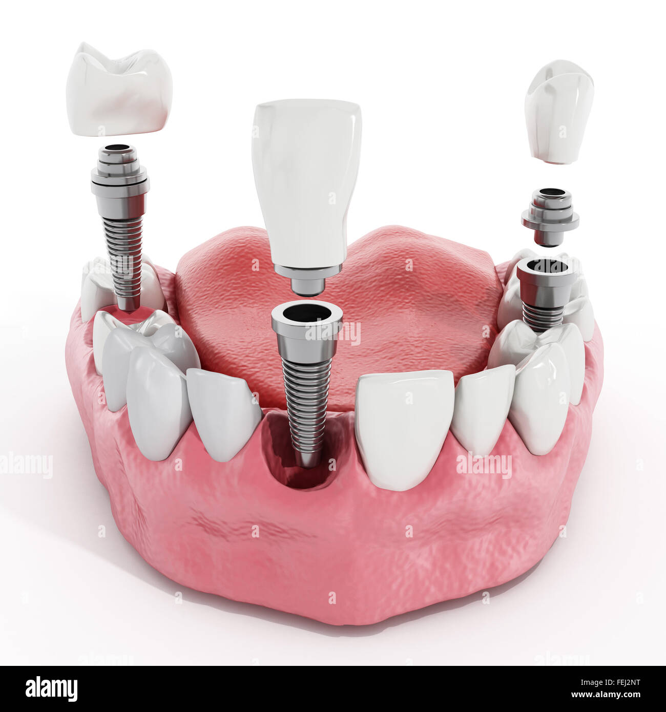 Illustration of teeth showing dental implant structure Stock Photo Alamy