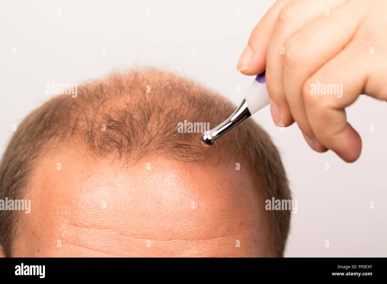 man controls hair loss stress alopecia cancer treatment Stock Photo - Alamy