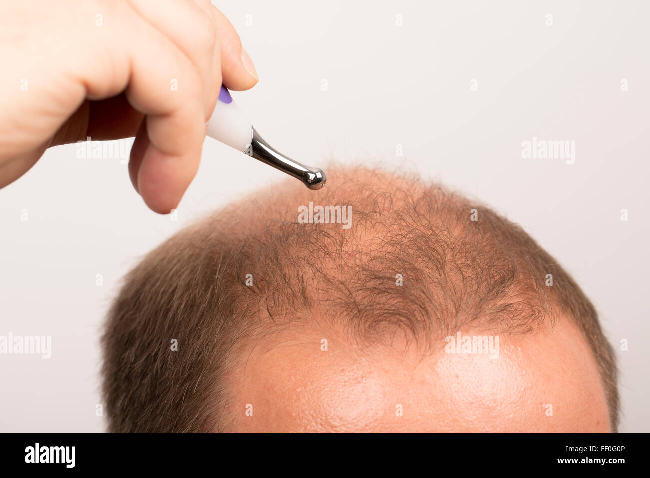 man controls hair loss stress alopecia cancer treatment Stock Photo - Alamy