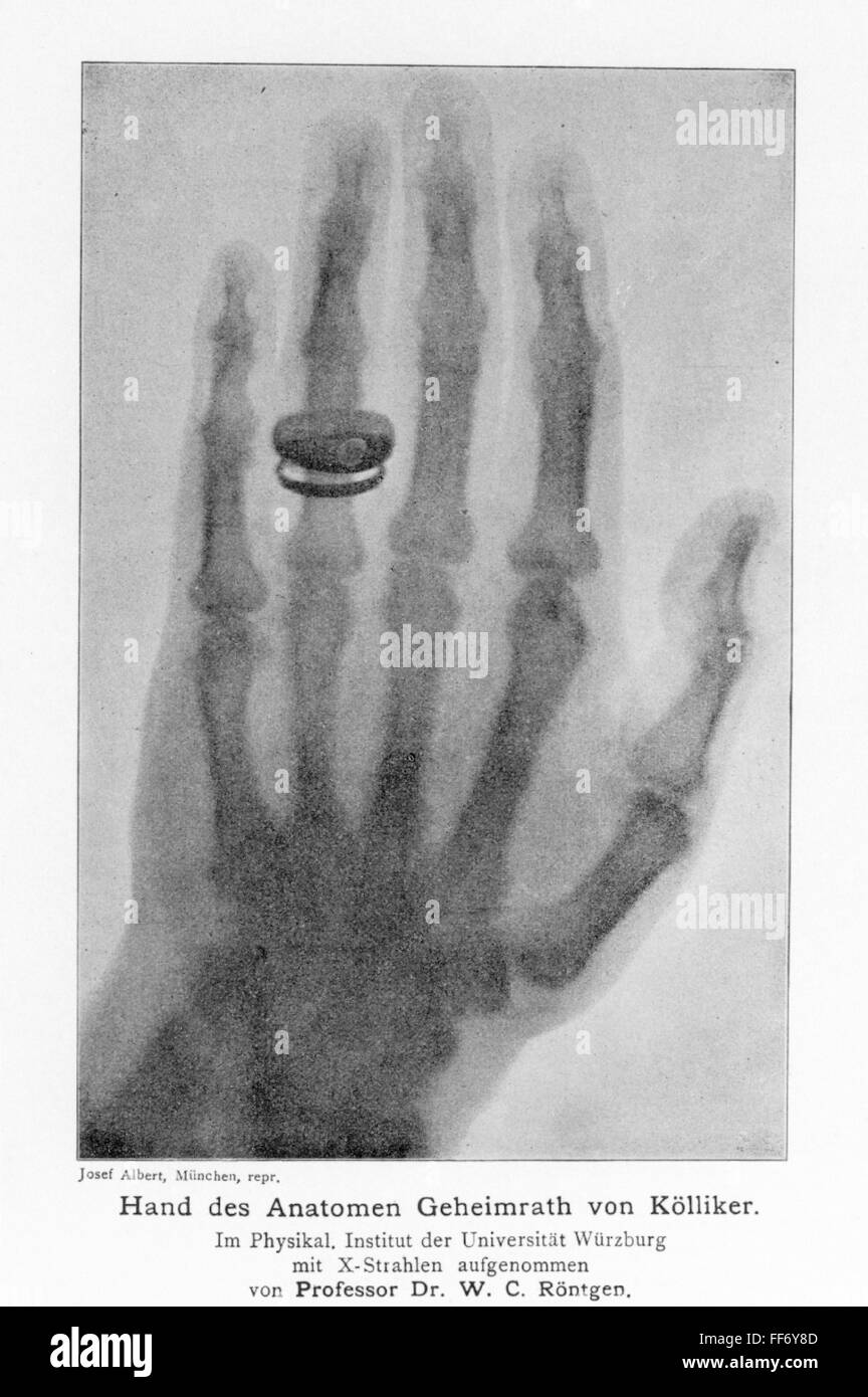 W. ROENTGEN: X-RAY, 1896. /nThe first published X-ray photograph, showing the left hand of Albert von K÷lliker, as reproduced in William Roentgen's paper announcing his accidental discovery of X-rays, 'Ueber eine neue Art von Strahlen,' in 'Sitzungsberich Stock Photo