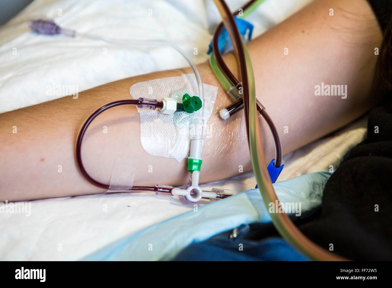 A cannula placed into a patient’s arm to collect blood for a stem cell donation transfusion in the London clinic, London, United Kingdom.  Once the stem cells have been separated off, the blood is return to the patient’s through their arm. Stock Photo