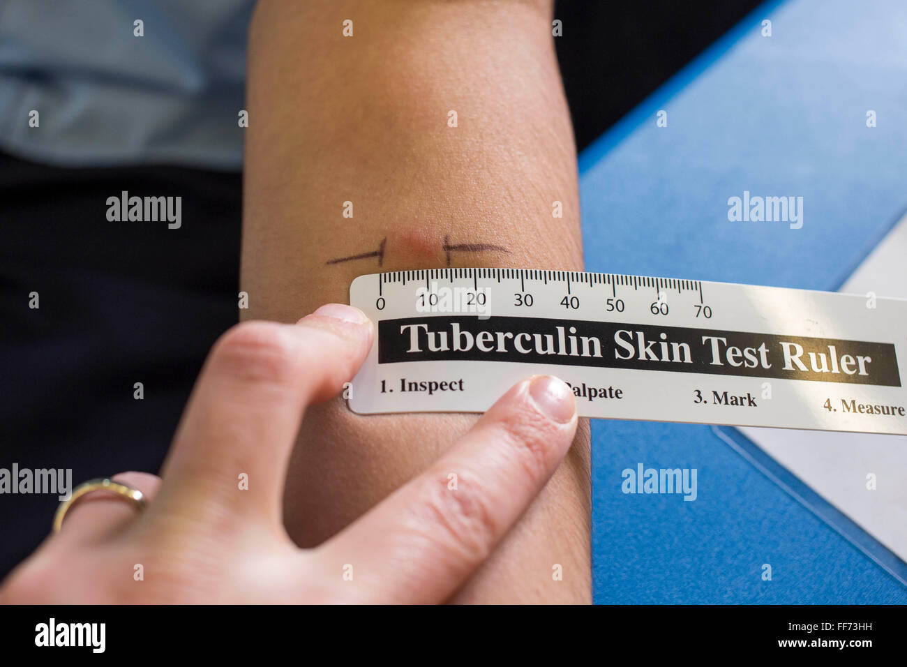 A reaction to the Mantoux PPD skin test is measured with a clinical ruler.  The test was administered as part of contact tracing to identify Latent TB Infection for someone who has been in close contact with a case of infectious tuberculosis. London, UK. Stock Photo