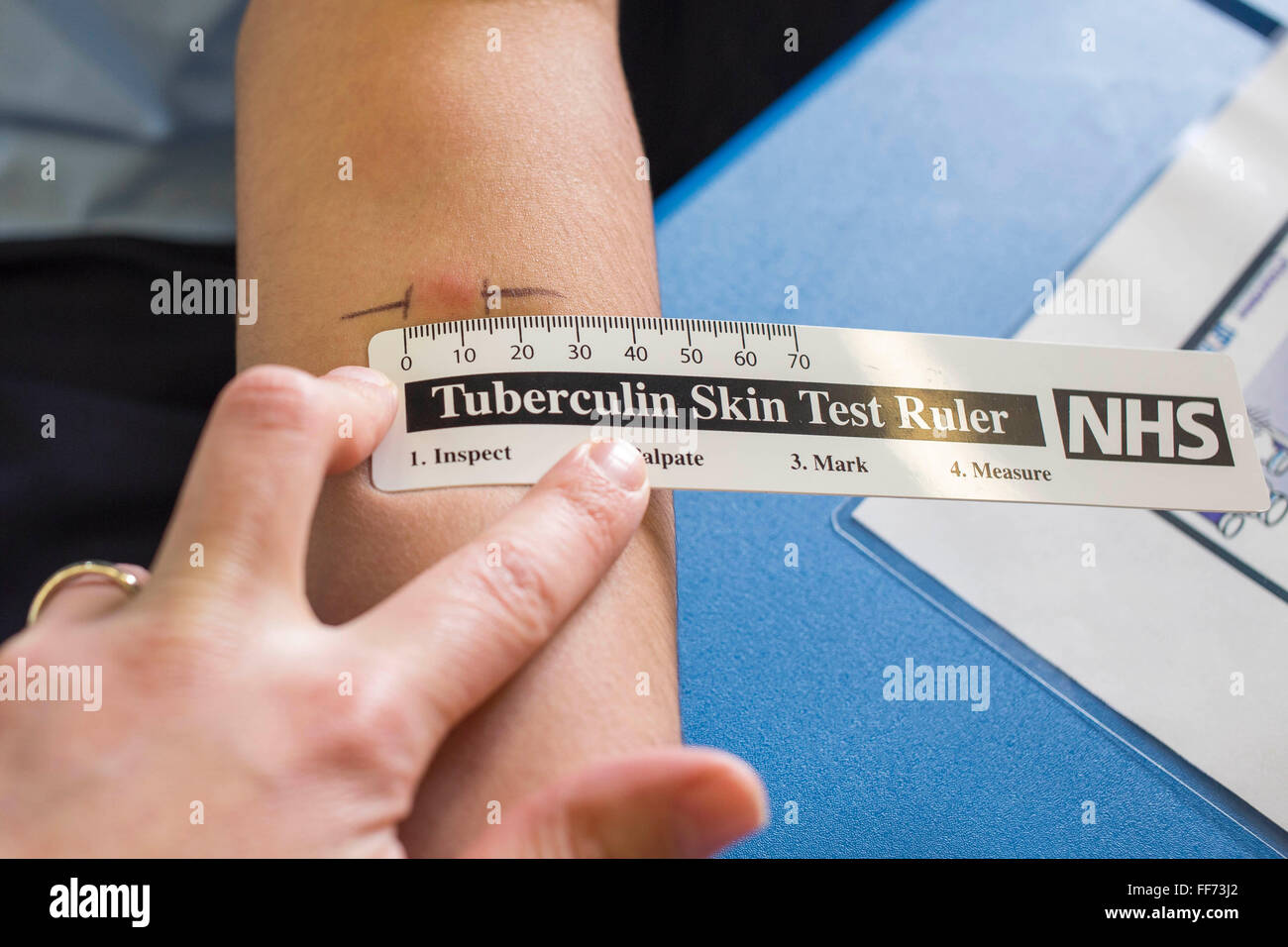 A reaction to the Mantoux PPD skin test is measured with a clinical ruler.  The test was administered as part of contact tracing to identify Latent TB Infection for someone who has been in close contact with a case of infectious tuberculosis. London, UK. Stock Photo