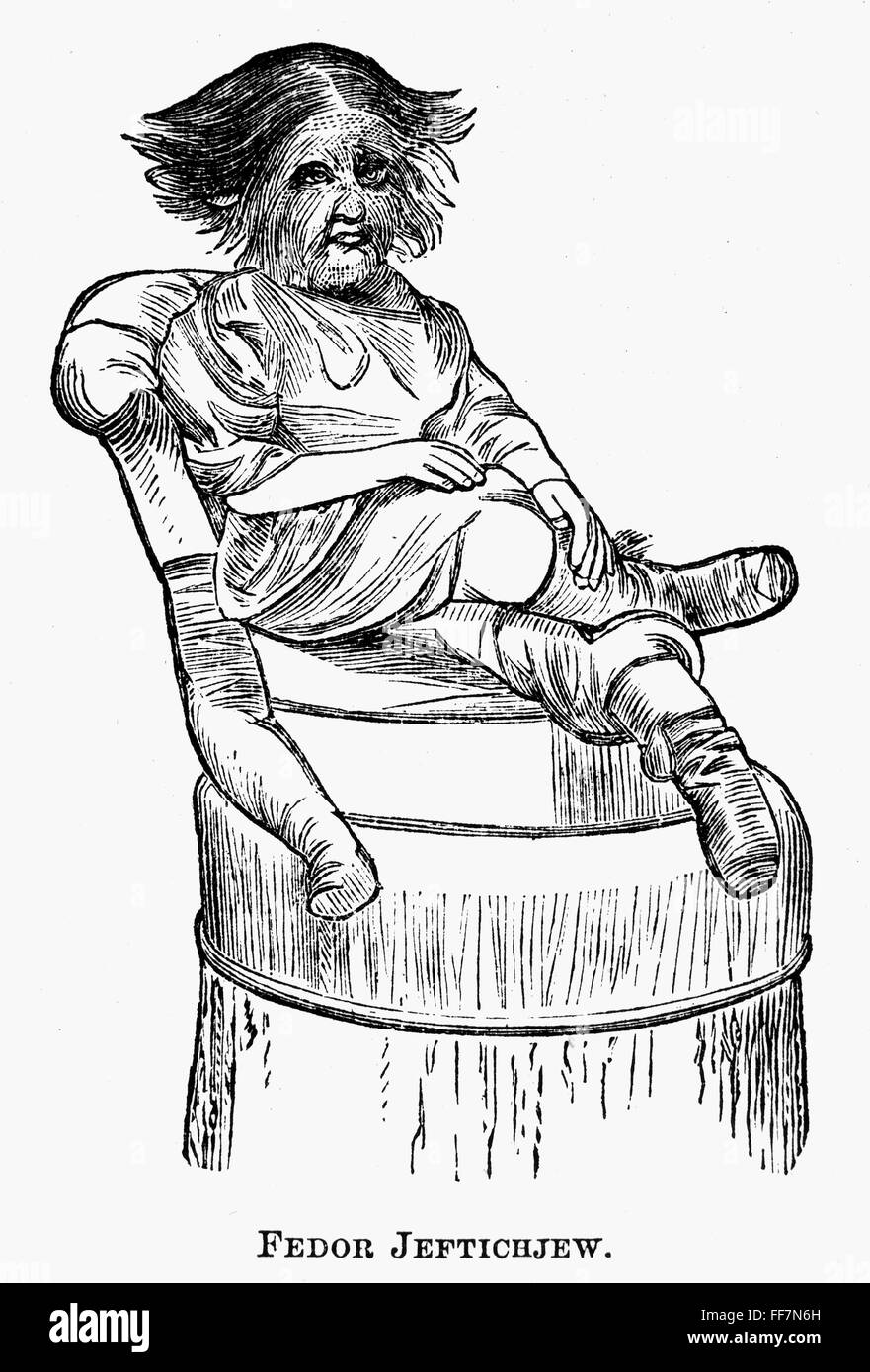 DOG-FACED BOY, 1874. /nFedor Jeftichjew, the original 'Jo-Jo, the Dog ...