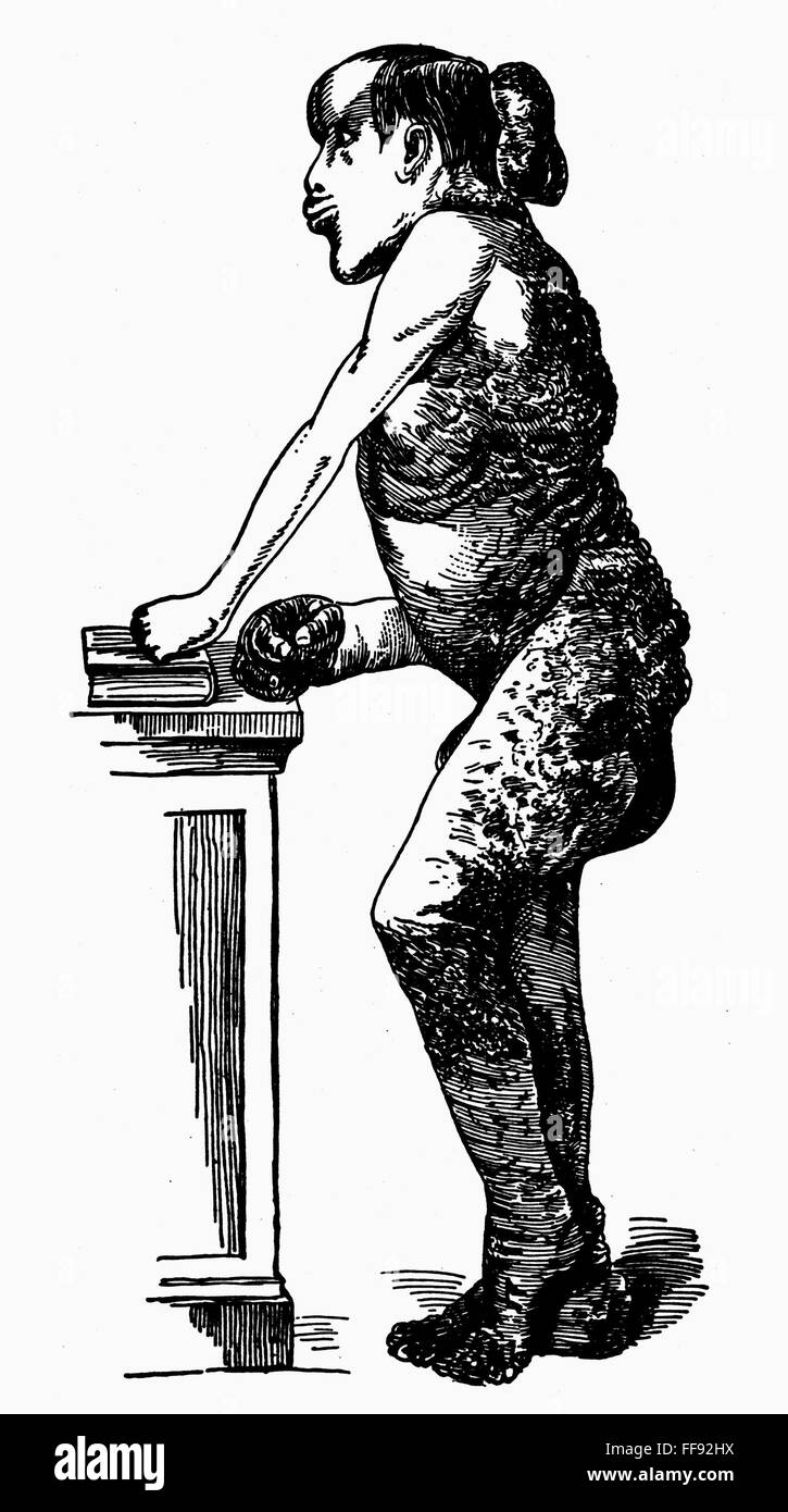 JOSEPH MERRICK (18641890). /nEnglish medical anomaly, known as the