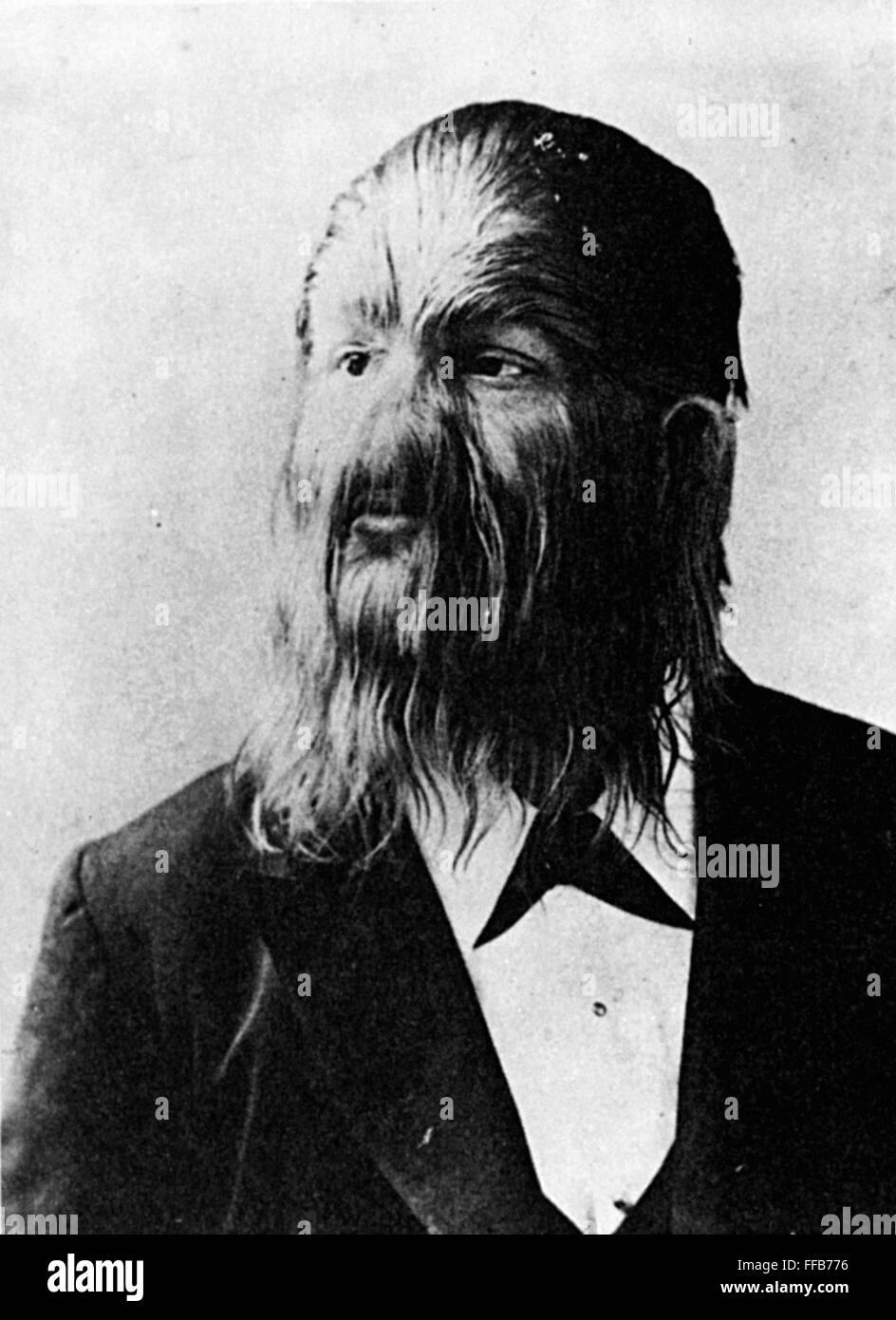 LIONFACED MAN. /nStephan Bibrowsky (18901932), known as Lionel the