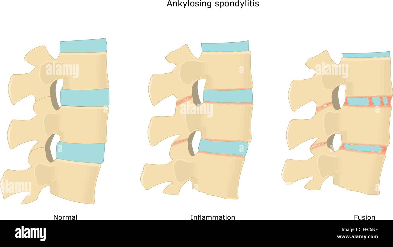 normal spine and a spine affected by ankylosing spondilitis Stock Vector