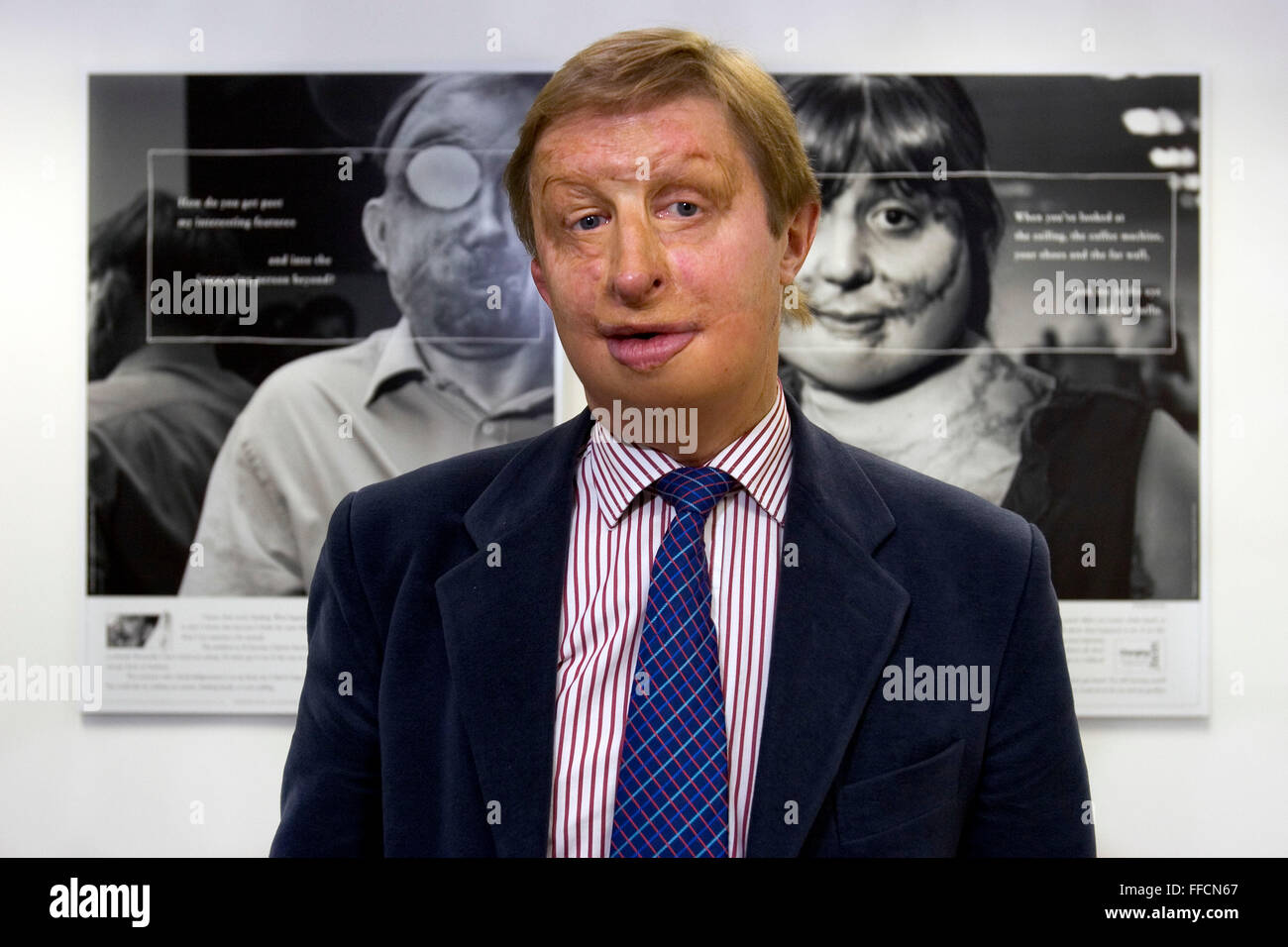 James Partridge, director of Changing Faces. Changing Faces is a national charity that supports and represents people who have disfigurement to the face or body from any cause. Stock Photo