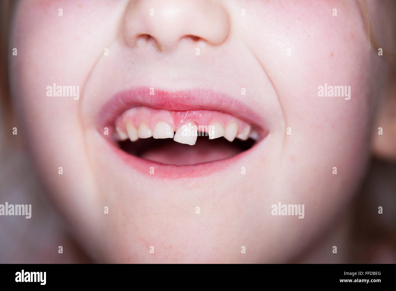 Child / five year old Child's loose front milk teeth / central incisor tooth which is about to
